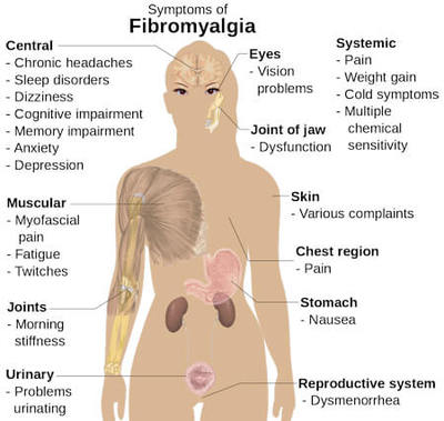 image shows a body with pointers to signs and symptoms of fibromalgia